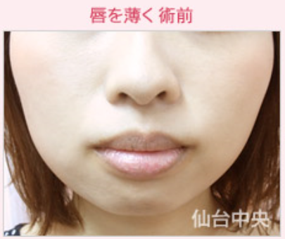 唇を薄く 口唇縮小術 たらこ唇 唇を薄くする整形の症例写真 画像 仙台中央クリニック Cs 美容医療の口コミ広場