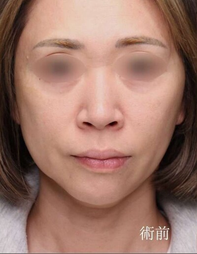 加齢による小鼻の広がりを小鼻縮小＋鼻孔縁下降で改善の症例写真[ビフォー]