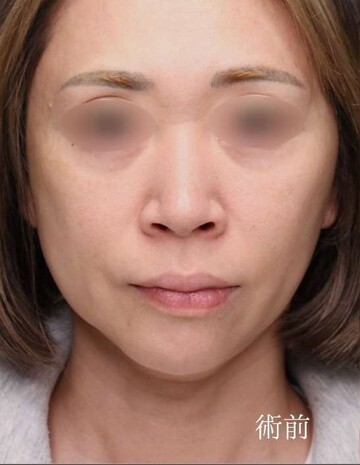 聖心美容クリニックの鼻の症例写真[ビフォー]