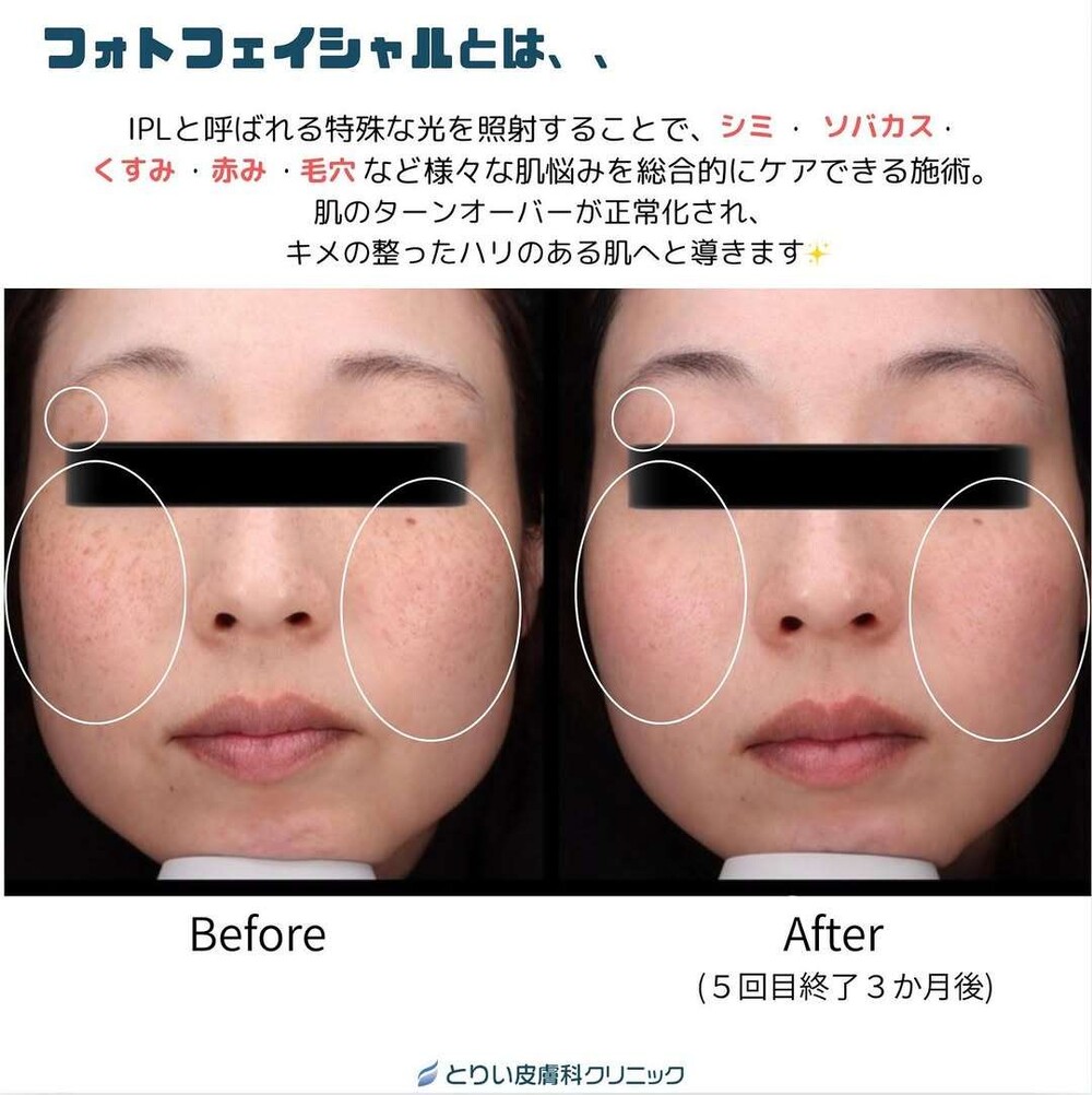 フォトフェイシャルの驚異的な若返り法 : あなたの素肌にはりと潤いを取り戻す! フォトフェイシャルで肝斑が悪化？真相と正しい治療法を解説