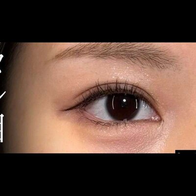 最強タレ目で可愛らしいお目元に💡の症例写真[アフター]