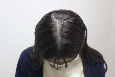 ヘアアートメイク｜20代｜2回の症例写真[ビフォー]