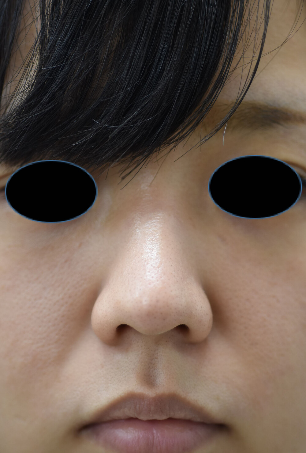 鼻柱引っ張る _ 鼻柱を伸ばす方法 自分で – 鼻柱の上げ下げ 診療案内 – XUZBE