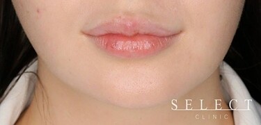 M字リップ ヒアルロン酸注入 口角ボトックス ヒアルロン酸注入 口元 唇 の症例 Select Clinic セレクトクリニック Cs 美容医療の口コミ広場