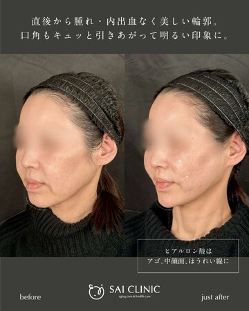 SAI CLINIC （サイクリニック）のリフトアップの症例写真