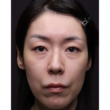 聖心美容クリニックの目元の症例写真[ビフォー]