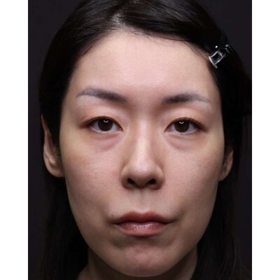 裏ハムラ法で疲れ顔の原因の影を改善（術後1ヶ月）の症例写真[ビフォー]