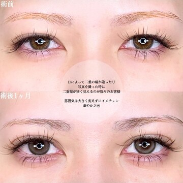 アリエル美容クリニック 大宮院の二重の症例写真
