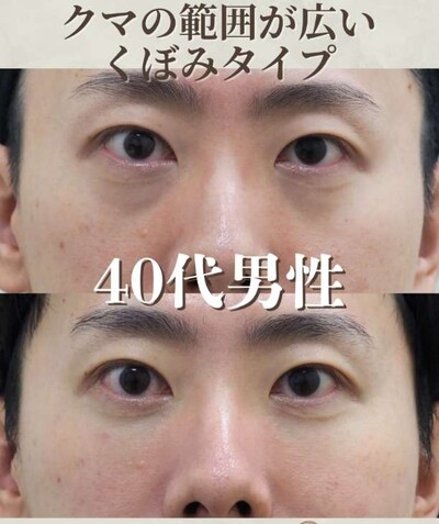 【筒井院長】40代男性 脱脂術＋ピュアグラフティングの症例写真
