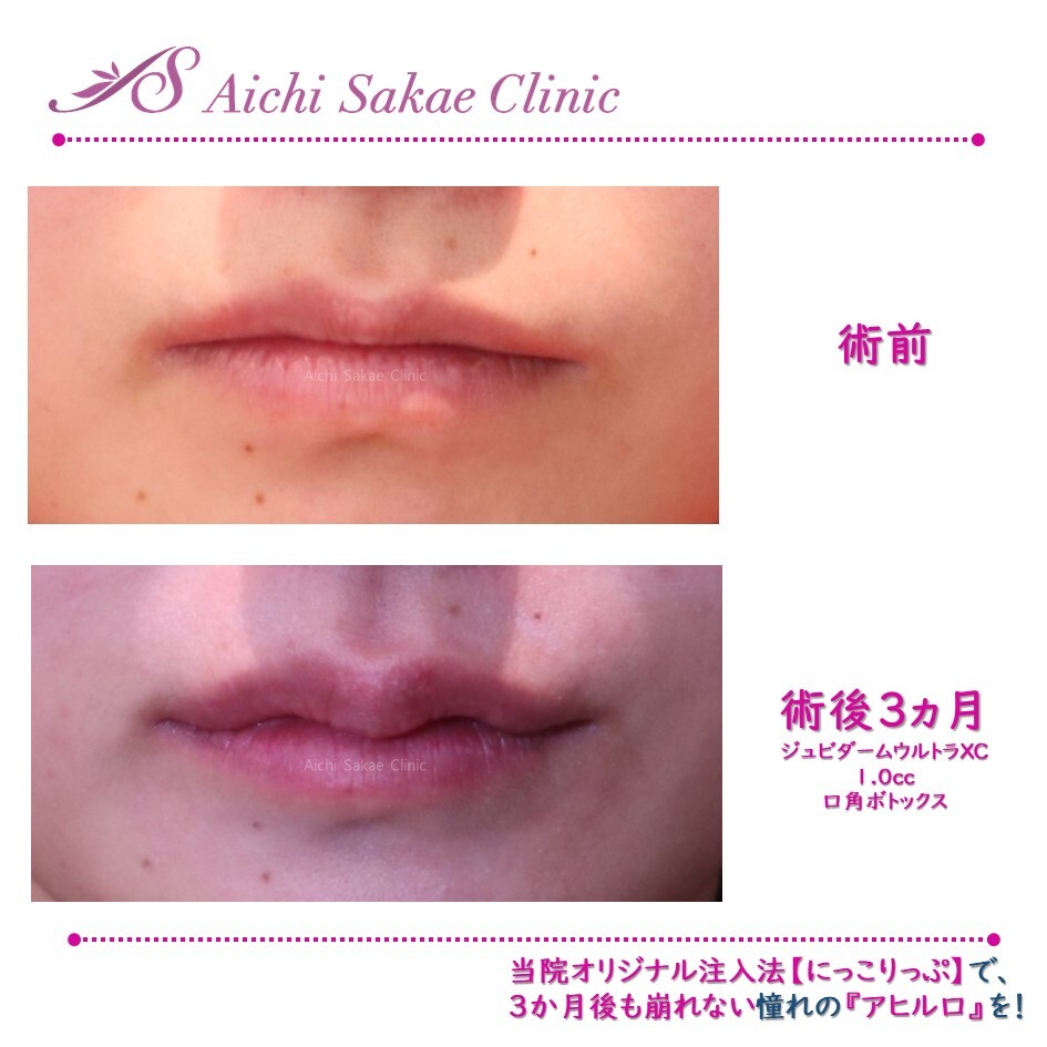 大人気施術の組み合わせで可愛い唇に 口元 唇の整形の症例写真 画像 あいち栄クリニック Cs 美容医療の口コミ広場
