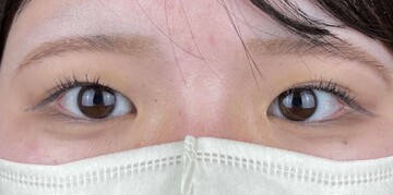 AI Beauty Clinicの二重の症例写真[ビフォー]