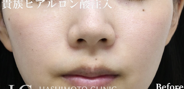 静岡美容外科橋本クリニックのリフトアップの症例写真[ビフォー]