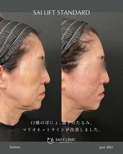 SAI LIFT STANDARDの症例写真