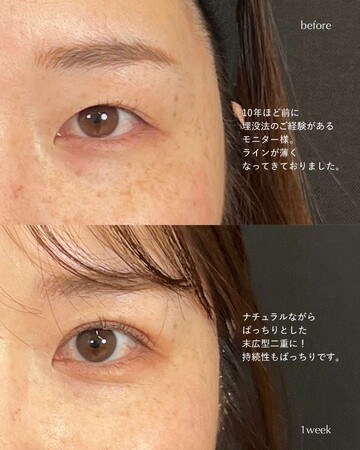 SAI CLINIC （サイクリニック）の二重の症例写真