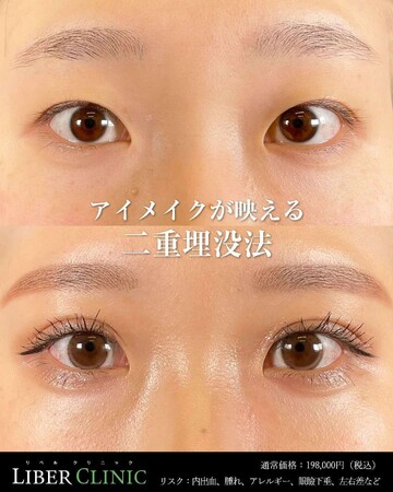 LIBER CLINIC （リベルクリニック）の目・二重整形の症例写真