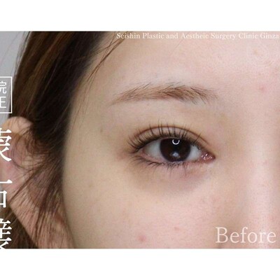 他院目頭切開後を蒙古襞形成（逆Z法）で修正の症例写真[ビフォー]