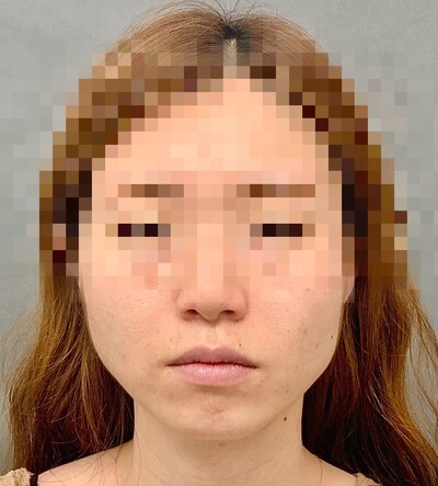 小顔整形 シャープな小顔に 顎の整形 ヒアルロン酸注入 輪郭 顎 その他 輪郭整形 エラ 小顔ボトックスの症例写真 画像 Tcb東京中央美容外科 渋谷西口院 Cs507 美容医療の口コミ広場