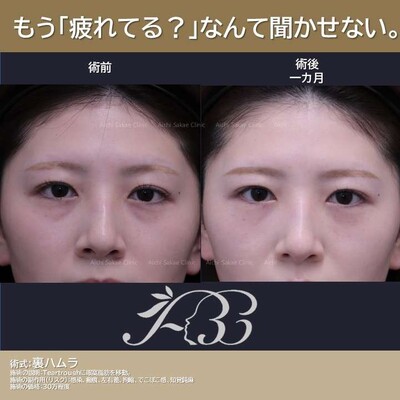 裏ハムラ単独でもここまで治る。（透け感は残る）の症例写真