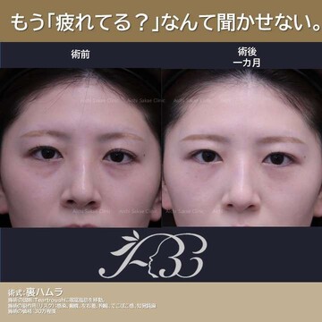 あいちビューティークリニック栄本院の目元・クマ・眉下・涙袋整形の症例写真
