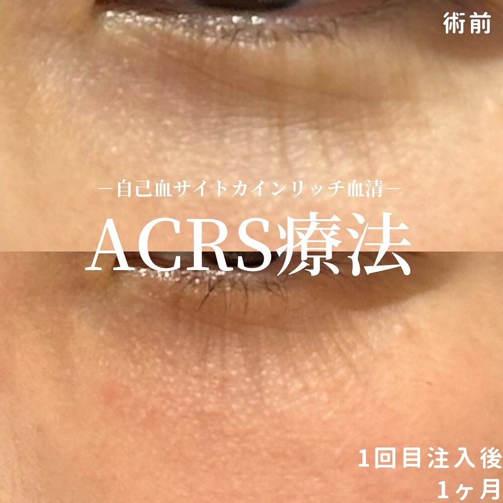 ACRS療法（再生医療・美容点滴）の症例写真 (CS78811)｜SOL CLINIC（ソルクリニック）《美容医療の口コミ広場》