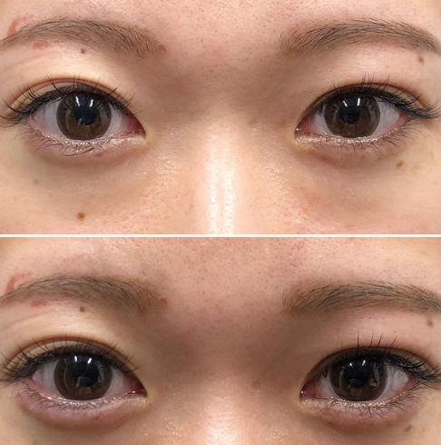 お綺麗です タレ目で自然で美しい涙袋希望 涙袋形成の症例写真 画像 しのぶ皮膚科 Cs 美容医療の口コミ広場