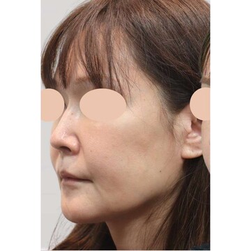 聖心美容クリニックのリフトアップの症例写真[ビフォー]