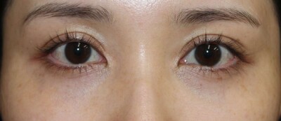 下まぶたのへこみへのヒアルロン酸の症例写真[ビフォー]