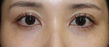 タウン形成外科クリニックの目元・クマ・眉下・涙袋整形の症例写真[ビフォー]