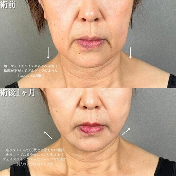 アリエル美容クリニック 大宮院のしわ・たるみ整形(注入、糸、フェイスリフト)の症例写真