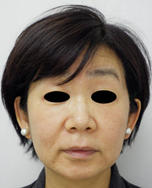 ヒアルロン酸注入によるリフトアップの症例写真[ビフォー]