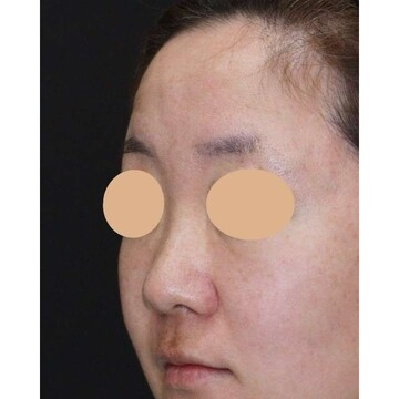 聖心美容クリニックの鼻の症例写真[ビフォー]