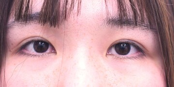 医療法人秀晄会 心斎橋コムロ美容外科クリニックの症例写真[アフター]