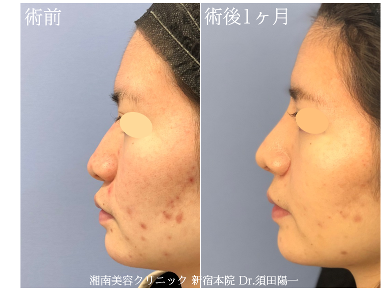 須田医師による鼻整形術 隆鼻術 鼻尖縮小術 小鼻縮小術の症例写真 画像 湘南美容クリニック 新宿本院 Cs435 美容医療の口コミ広場