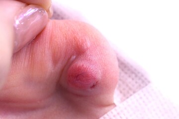 医療法人秀晄会 心斎橋コムロ美容外科クリニックの傷跡治療、ケロイドの症例写真[ビフォー]