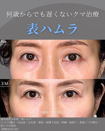 何歳からでも遅くないクマ治療【表ハムラ】の症例写真