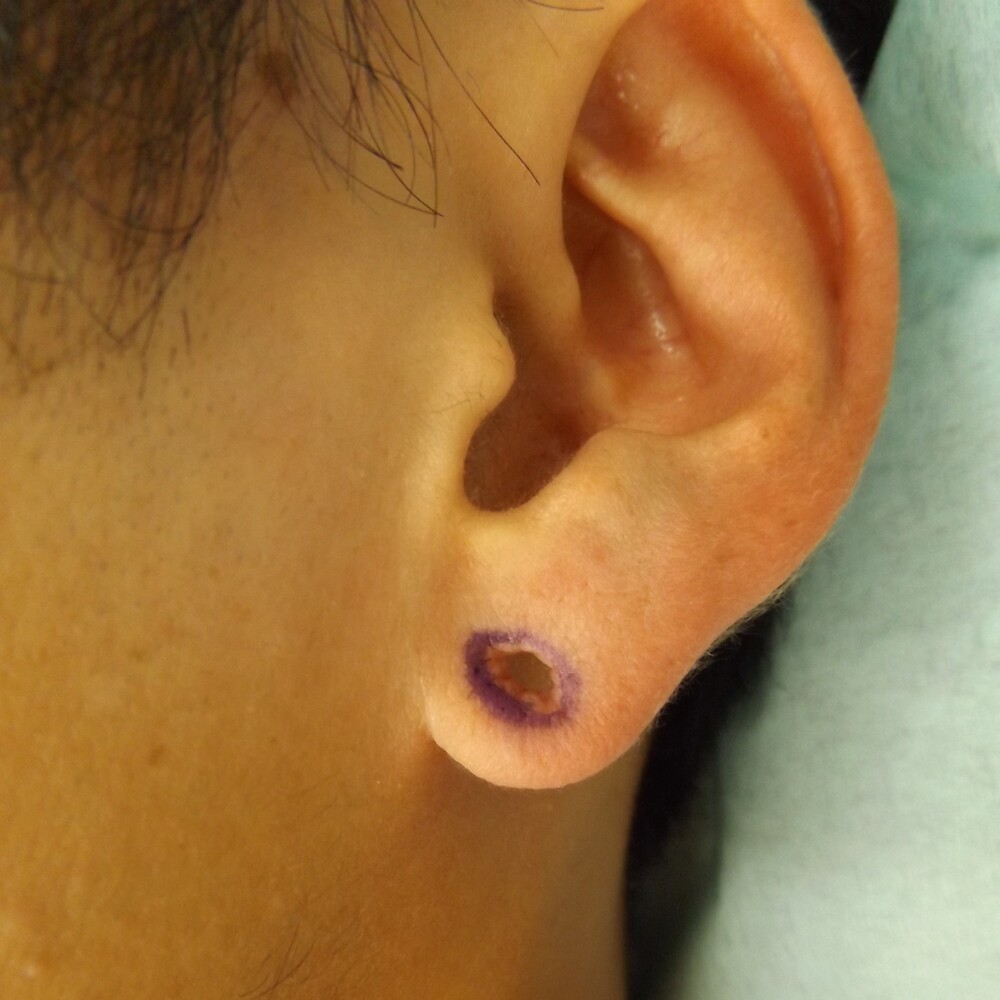 ピアス穴閉じ (傷跡治療、ケロイドの症例写真・画像) 医療法人 陽水会 西新宿杉江中央クリニック (CS45379)《美容医療の口コミ広場》
