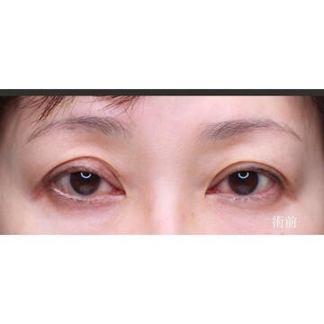 聖心美容クリニックの二重の症例写真[ビフォー]
