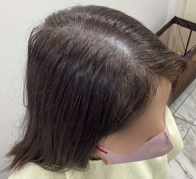 ヘアアートメイク｜60代｜2回の症例写真[アフター]