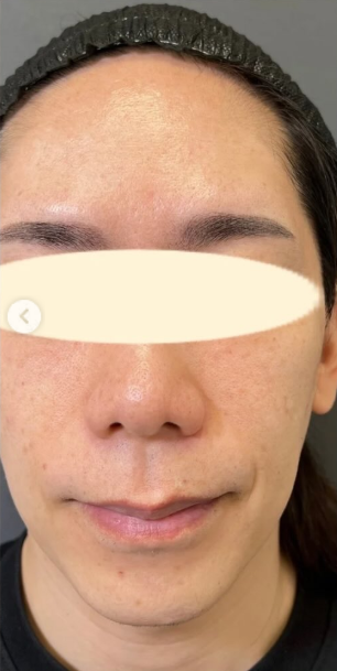 Plume Clinicの口元・唇の整形・人中短縮の症例写真[ビフォー]
