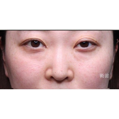 裏ハムラ法でふくらみと凹みの影を解消（術後1ヶ月）の症例写真[ビフォー]