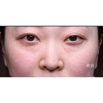 聖心美容クリニックの目元の症例写真[ビフォー]