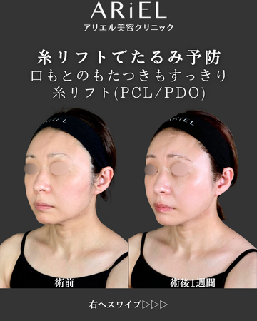 アリエル美容クリニック 郡山院のしわ・たるみ整形(注入、糸、フェイスリフト)の症例写真