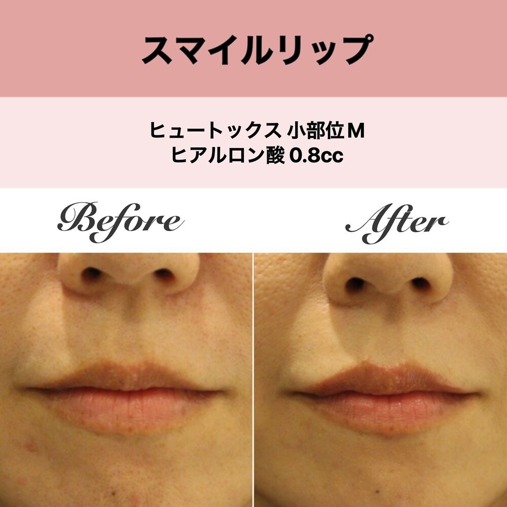 リップス 口唇の美容治療のための注入テクニック45 （Quint-Med） リップス: 口唇の美容治療のための注入テクニック45 (Quint-Med