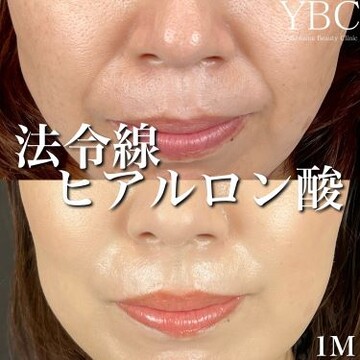 YBC横浜美容外科 立川院のリフトアップの症例写真