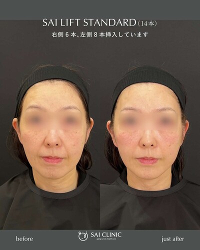 糸リフト（SAI LIFT STANDARD）14本の症例写真