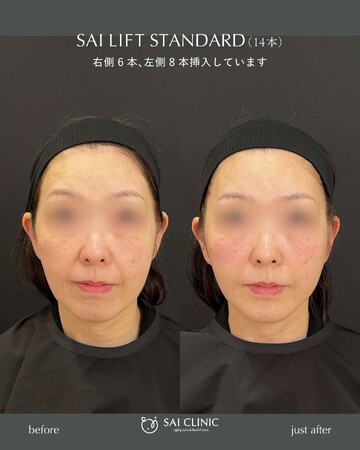 SAI CLINIC （サイクリニック）のリフトアップの症例写真