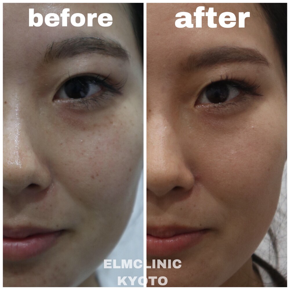フォトフェイシャルn２２によるそばかす治療 フォトフェイシャルの症例写真 画像 美容皮膚科 エルムクリニック 京都院 Cs4 美容医療の口コミ広場