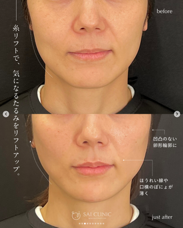 SAI CLINIC （サイクリニック）のリフトアップの症例写真