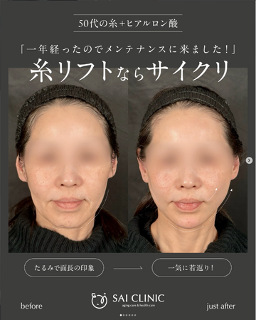 SAI CLINIC （サイクリニック）のリフトアップの症例写真