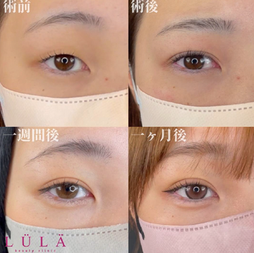 ルラ（LULA）美容クリニックの目・二重整形の症例写真